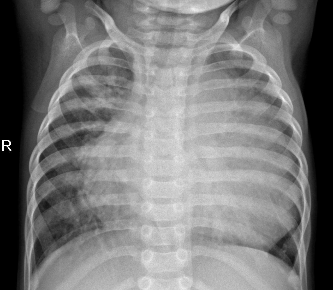 Pneumonia detection thumbnail